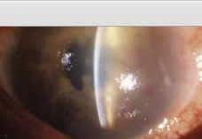 Uveitis