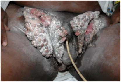 ISandhu, R., Min, Z., & Bhanot, N. (2014). A gigantic anogenital lesion: Buschke-Lowenstein tumor. Case reports in dermatological medicine , 2014 .mage source: