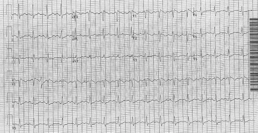 EKG in a patient with a tricyclic antidepressant overdose. The QRS duration here was 122 ms. Note the tall R' in aVR, which is more subtle than the diphenhydramine overdose EKG above. 
