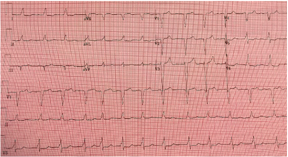 Repeat EKG #2, after treatment for hyperkalemia