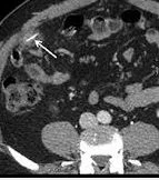perforated intestine from a grill brush wire.