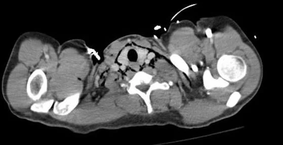 What do you notice on theCT image?