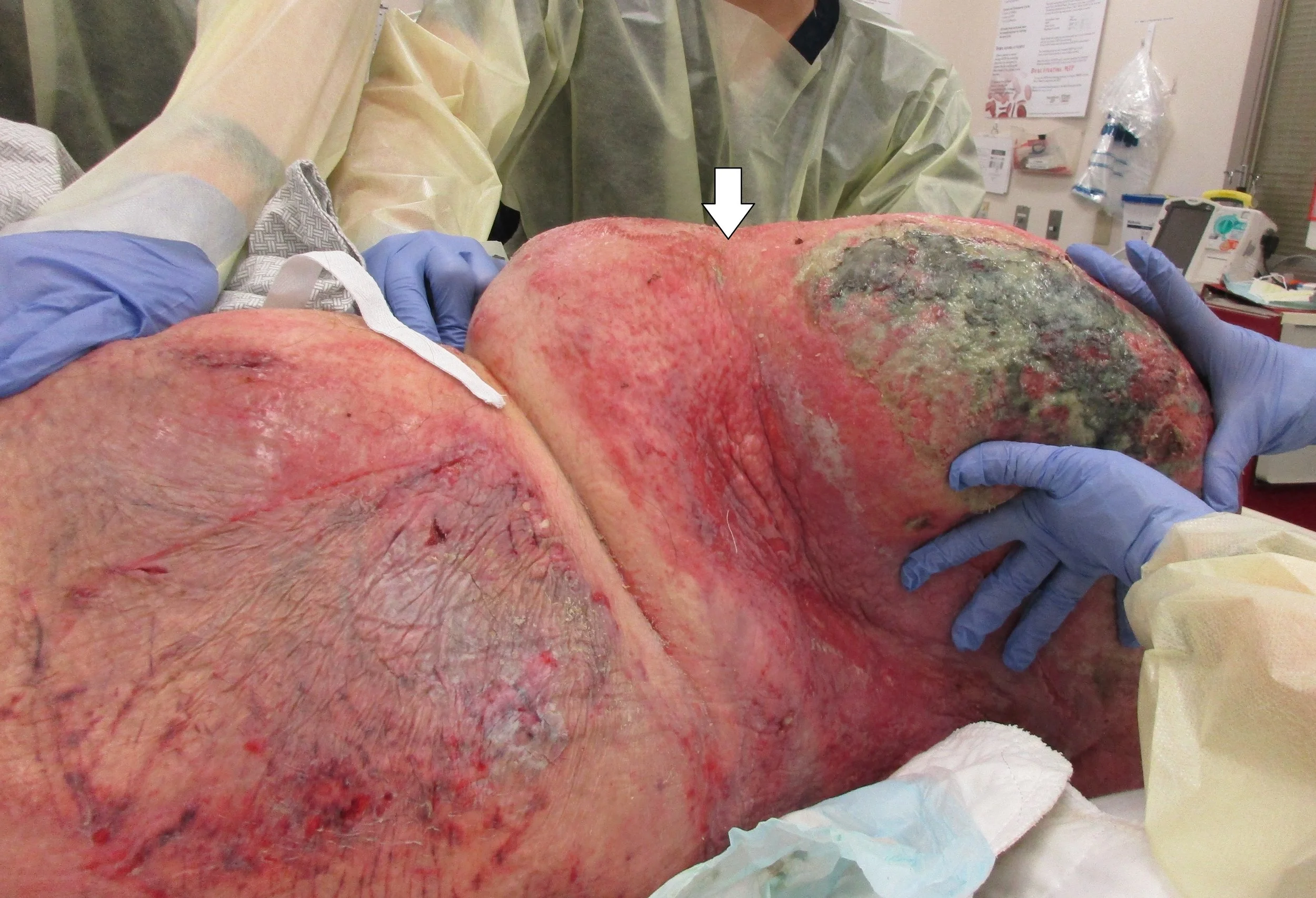 the arrow represents her hip. What is this condition?