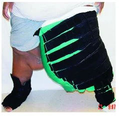 compression for lymphedema