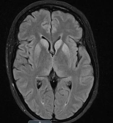 What does her MRI show?