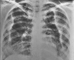 Cutaneous larva migrans (hookworm) of the lung: Loeffler's syndrome.