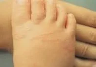 Peripheral rash associated with hookworms.