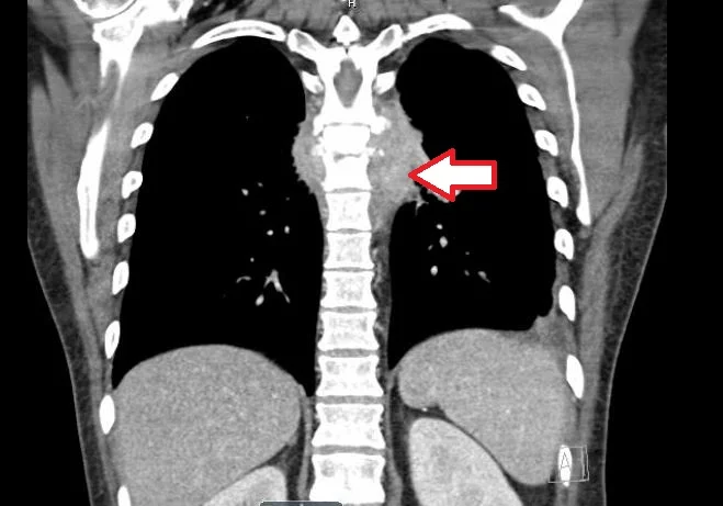 epidural abscess meyerf.jpg