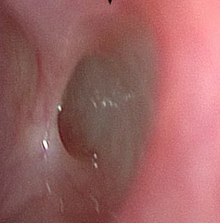 close up of the Vomeronasal organ on the septum