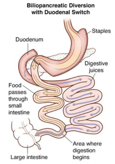 this procedure leads to weight loss with the possibility of malnutrition especially thiamine deficiency.
