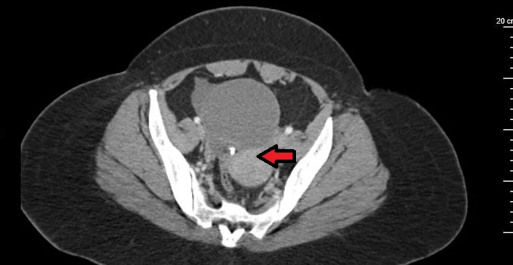Arrow points to the uterus.