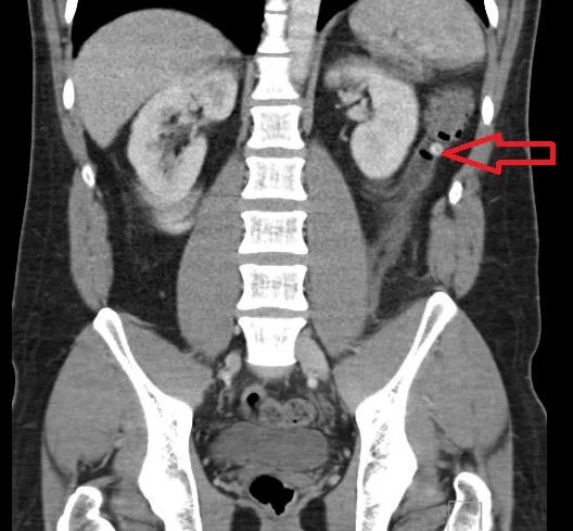 our patient with a L sided diverticulum