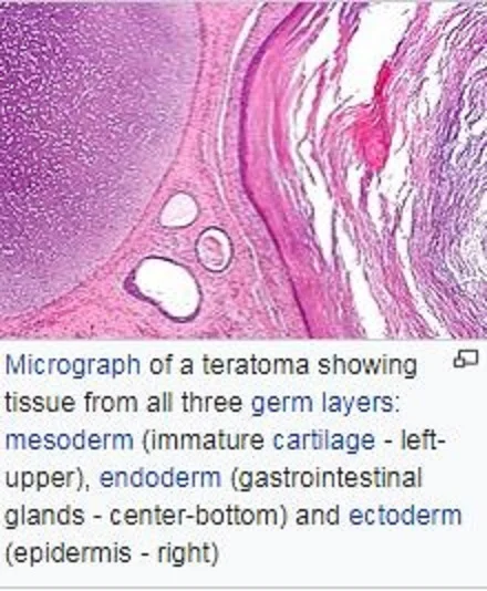 teratomapath.jpg