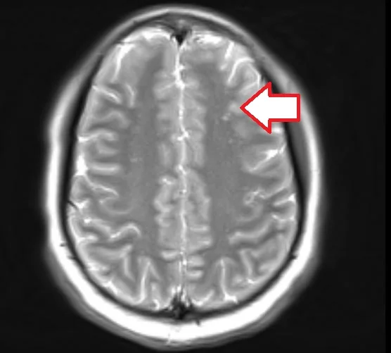 mini infarct in the brain on her T2 weighted images.
