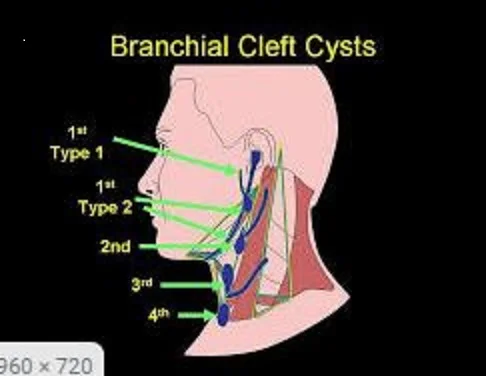 branchial cleft cysts