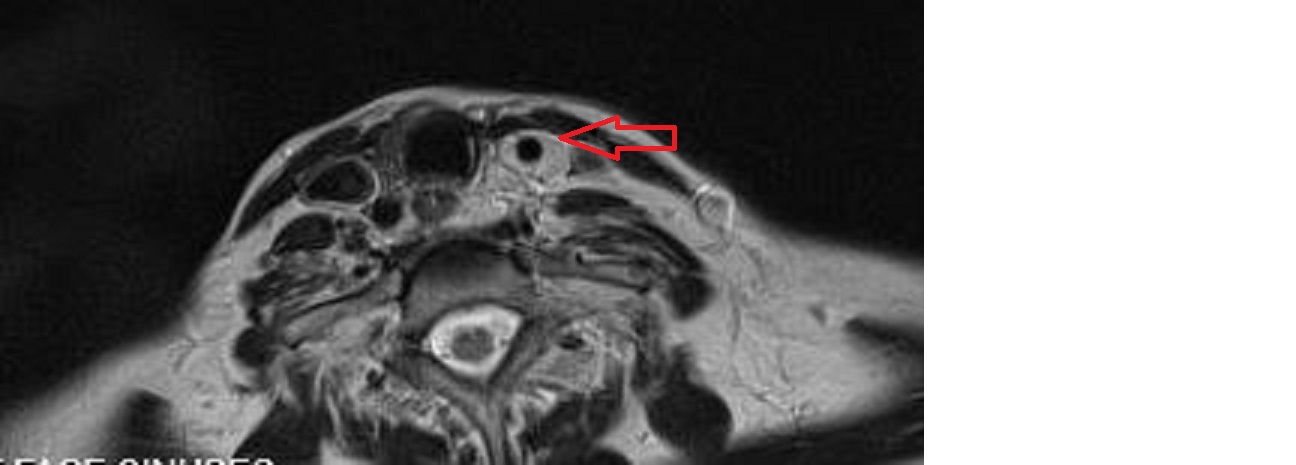 But the lesion surrounds the carotid without compressing it and also extends into the mediastinum. What is it?