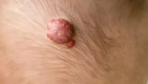 hemangioma in a child