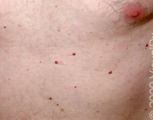 common cherry hemangiomas