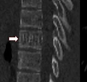 the “corduroy sign” of spinal hemangiomas