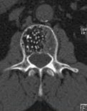 cross section of the spinal hemangioma “the polka dot sign”