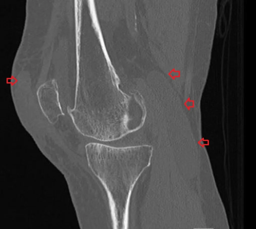 A 73 y.o. woman comes in after a fall and has severe knee pain