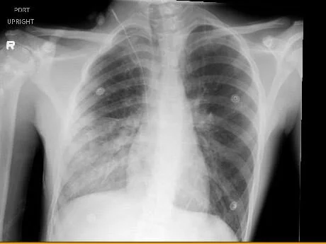 sons xray 24 hrs after admission What could have happened?