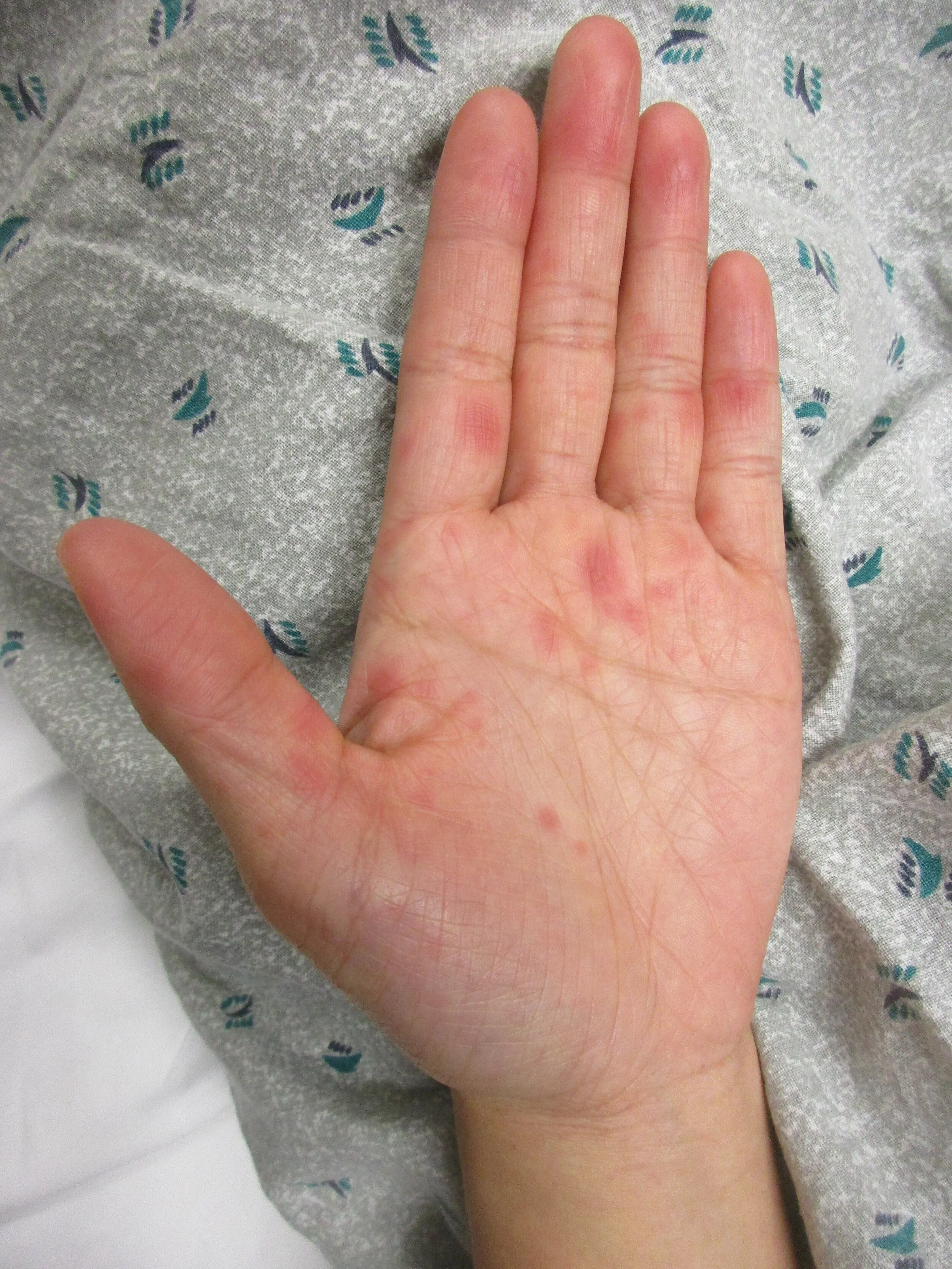 A 24 y.o. Asian woman presents with a rash on her palms and soles ...