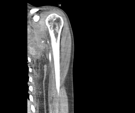 A 51 Y O Woman Presents With Fever And L Biceps Pain Everyday E B M