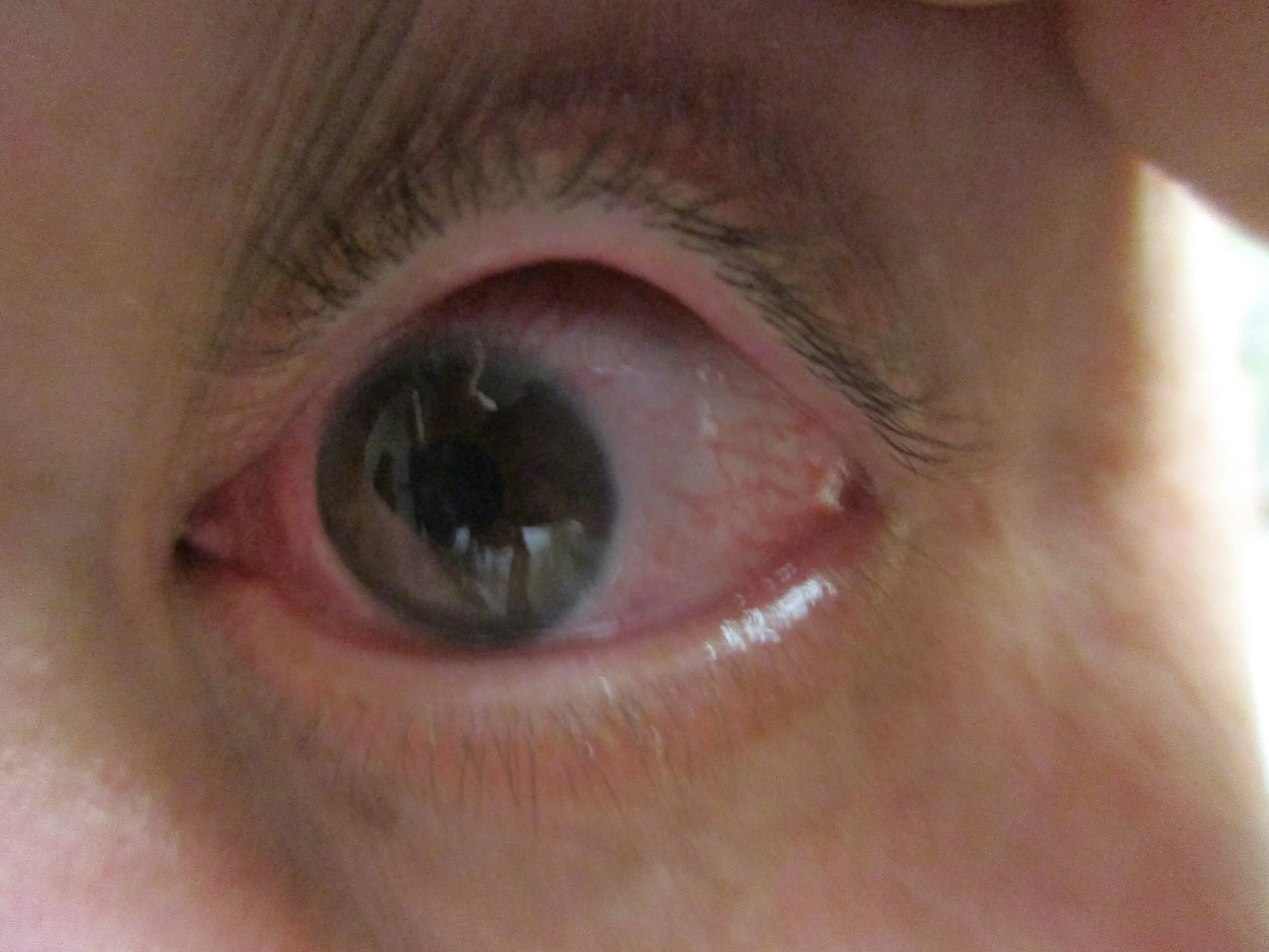 A 51 Y o Diabetic Comes In With Sudden Onset Of Severe Pain In The L Eye Everyday E B M