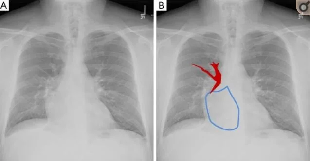 A 91 y.o. with a hx of partial anomalous pulmonary venous return ...