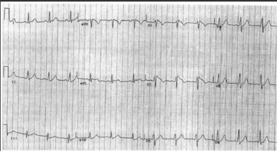 brugadas cocaine.JPG