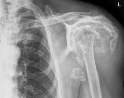 cpp shoulder.JPG