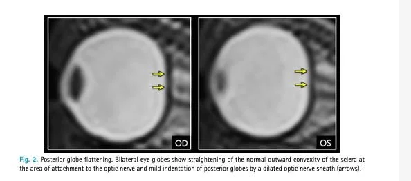 A 38 y.o construction worker with a hx of Graves disease presents with ...
