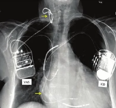 vagal nerve stim.JPG