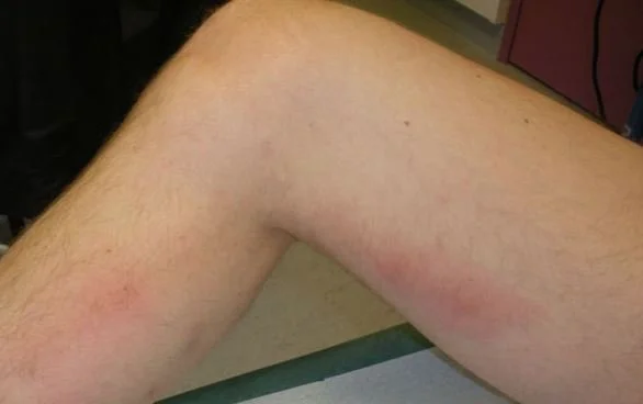 superficial thrombo.JPG