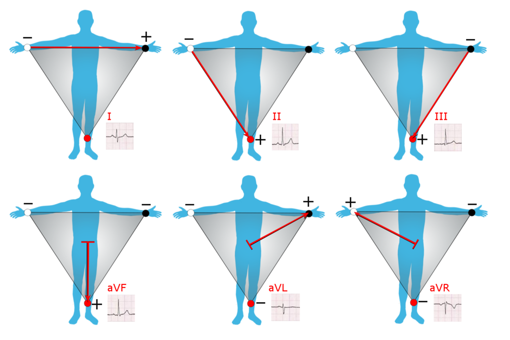 1000px-Limb_leads_of_EKG.png