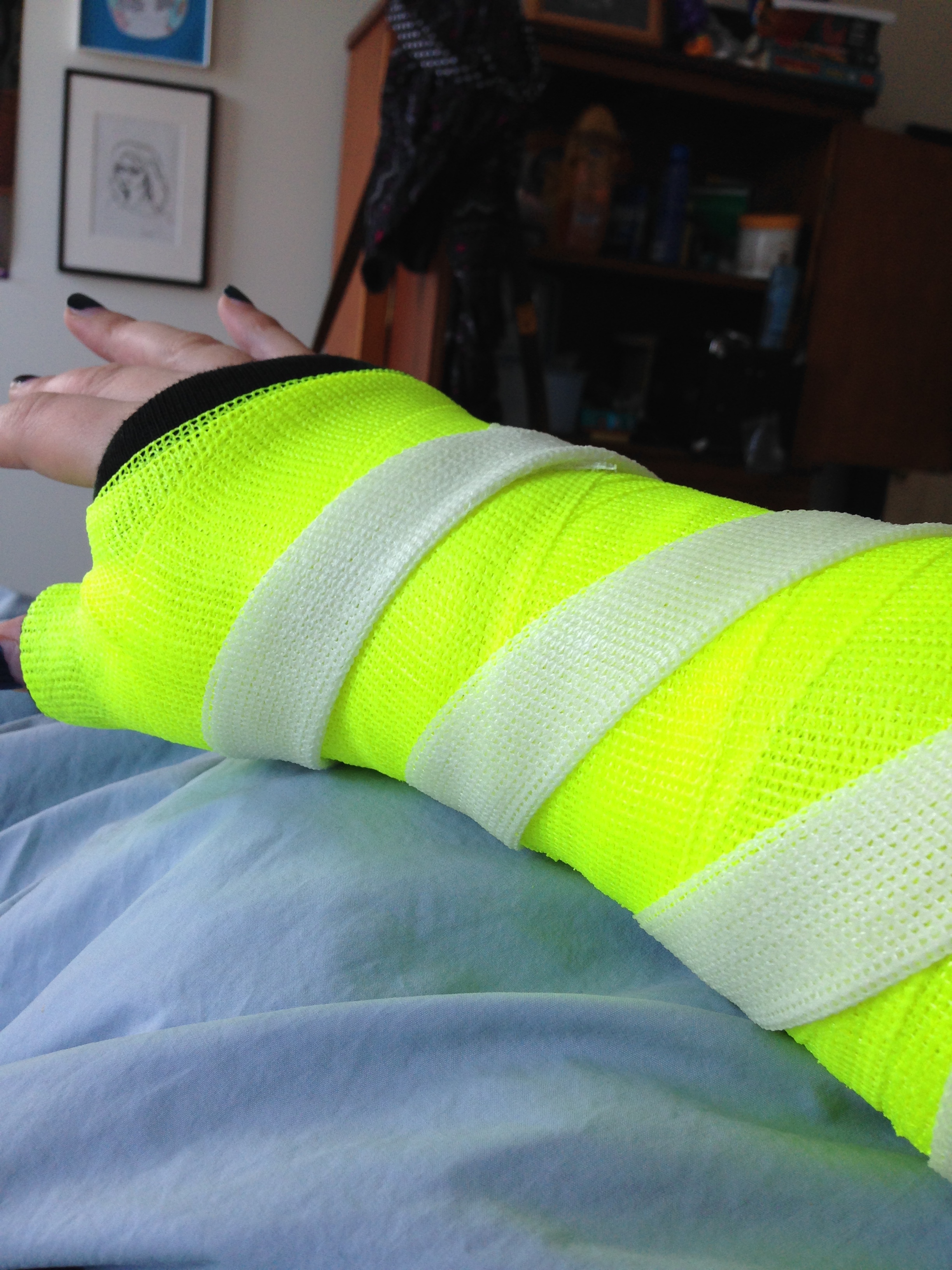 I decided on a neon yellow cast with a glow in the dark stripe.