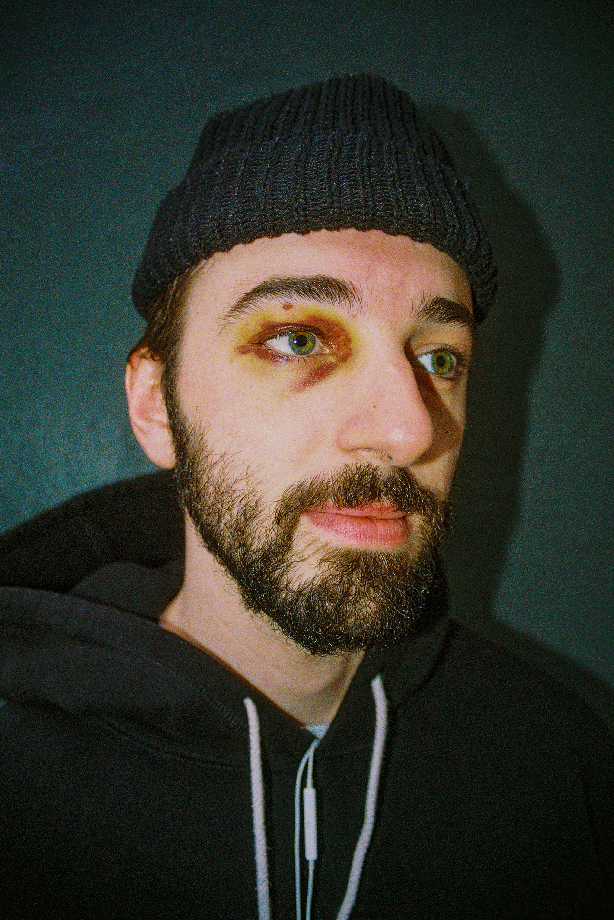 Colin Lyon with his black eye