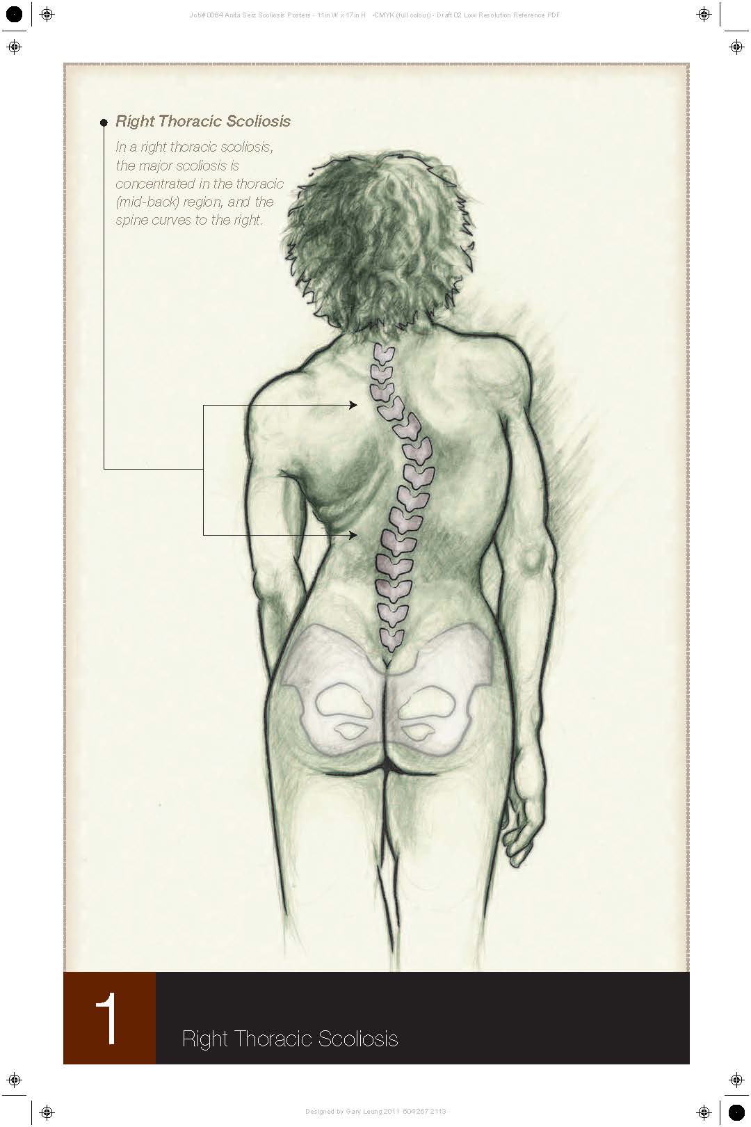Scoliosis Curve - Thoracic Spine.jpg