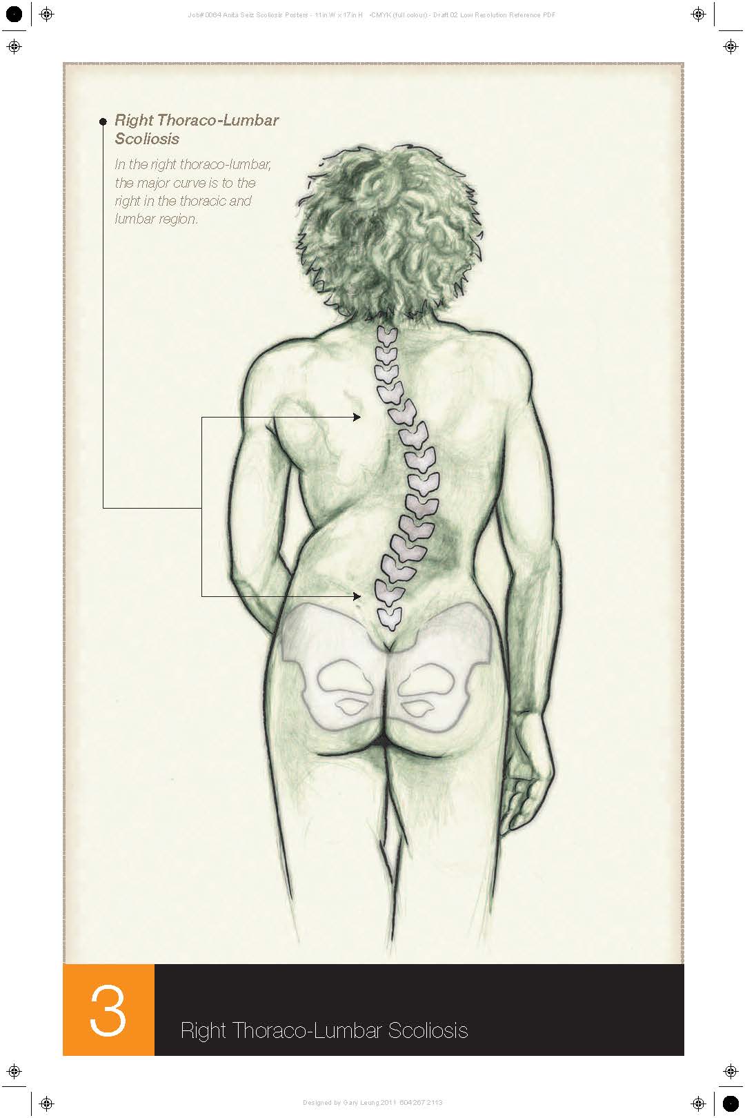 Scoliosis_Posters_CMYK_R02_Lres_Page_3.jpg