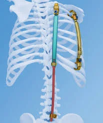 Example of Vertical Expandable Prosthetic Titanium Rib Device (VEPTR®)