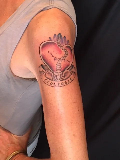 A Testimony on Life with Scoliosis: Scoli Girl by Cindy Heidel