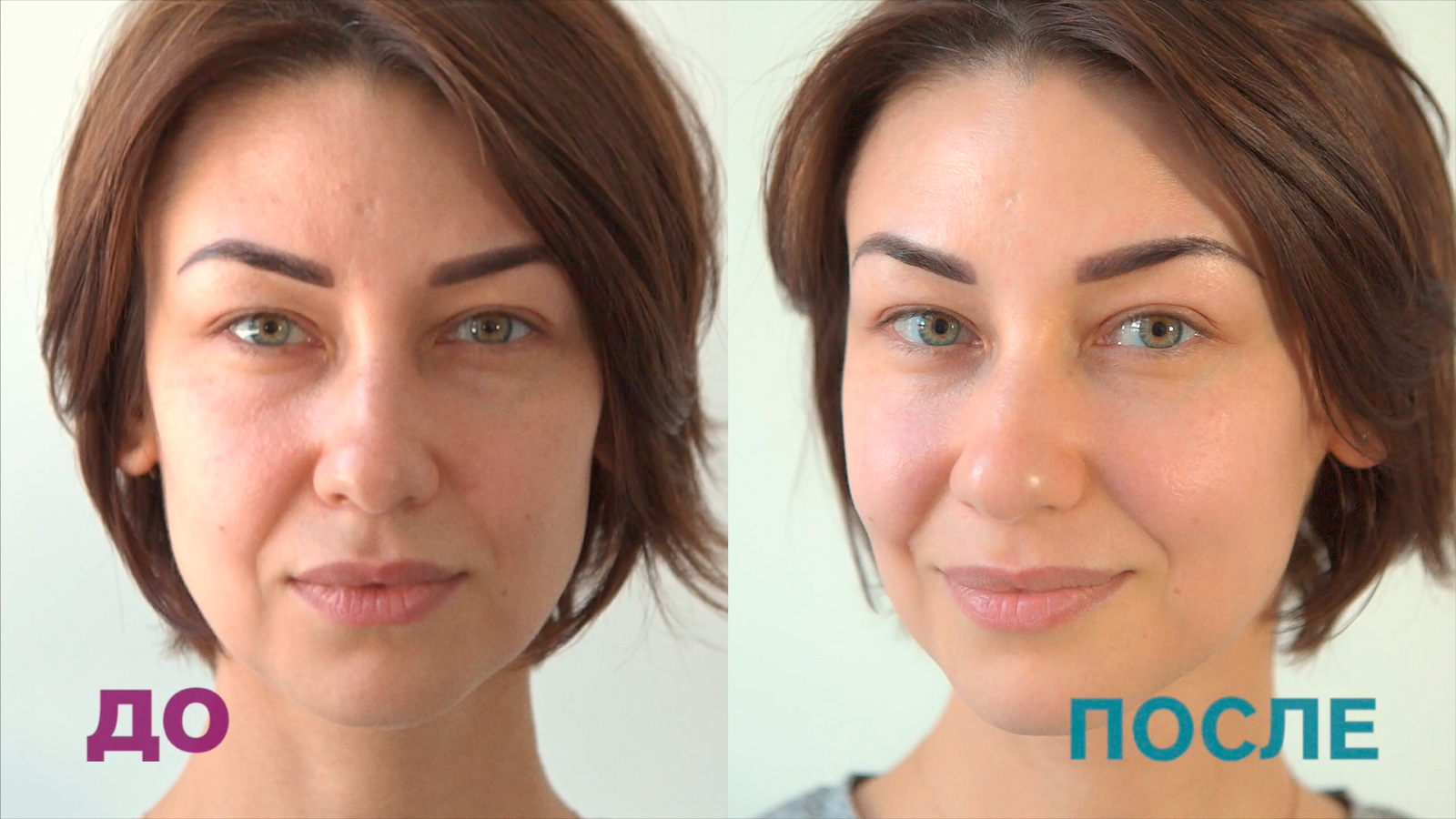 Подает лицо. Микротоки для лица до и после. Микротоковая терапия до и после. Массаж лица до и после. Микротоковая терапия для лица до и после.
