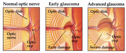 Glaucoma