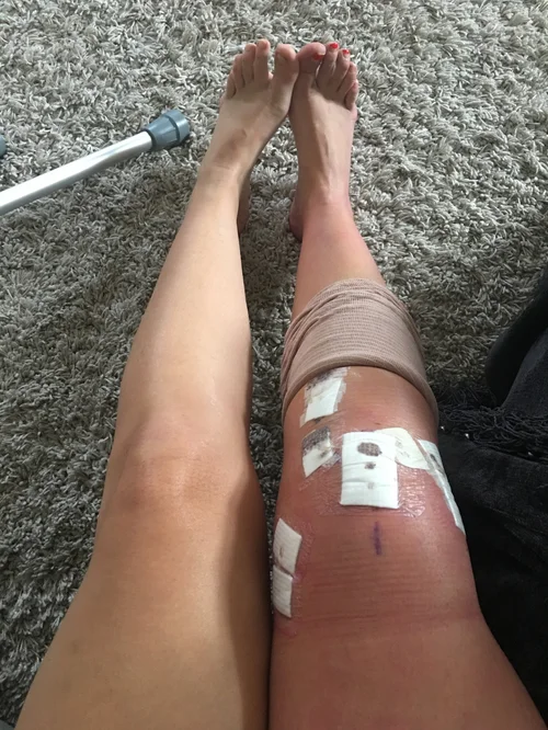 How To Prepare For Knee Surgery Live With Elle