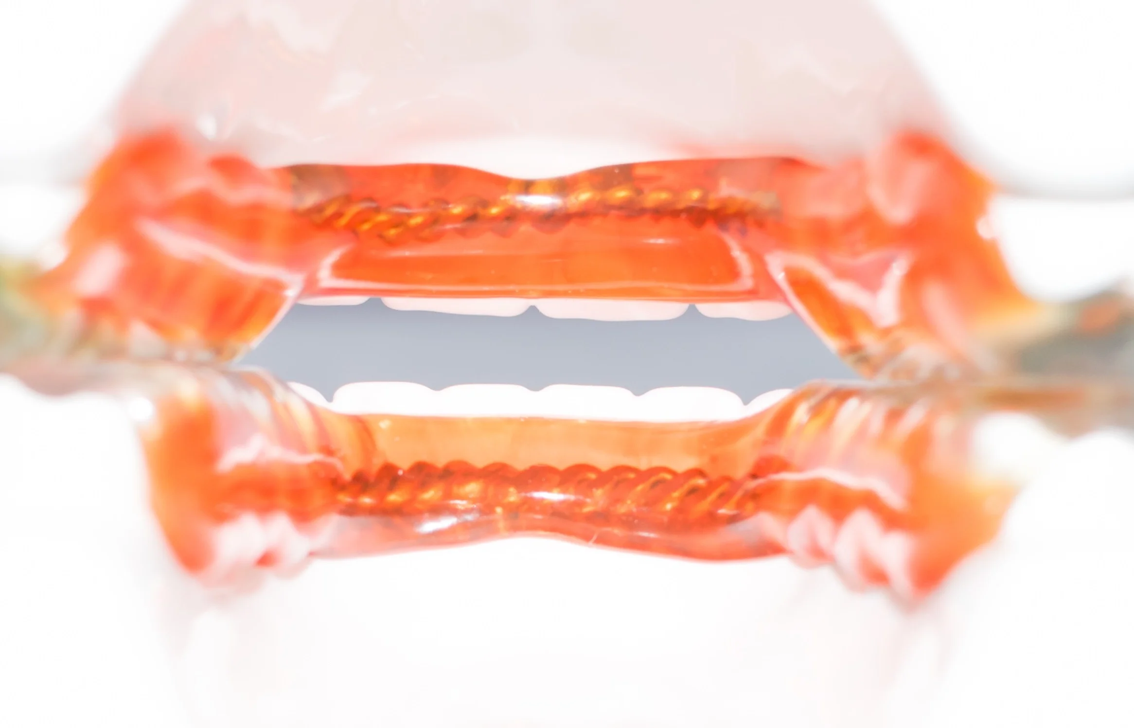 Picture 6: The rear view of the device further illustrates a truly open anterior. We make sure to keep the lingual areas of the devices as thin as possible, allowing for maximum tongue space and comfort. Please note the orange shading is for illustration purposes only. All devices are made in clear acrylic.
