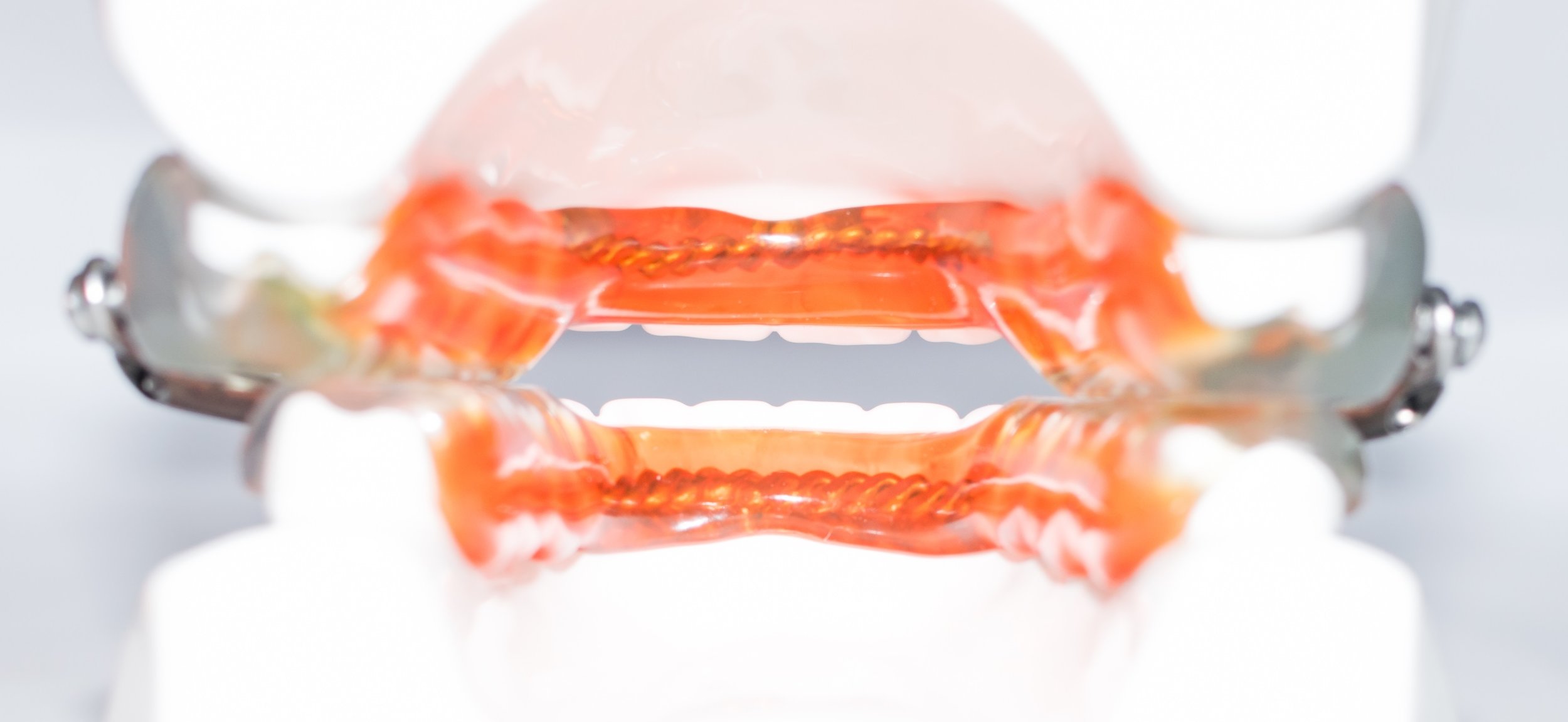 The rear view of the device further illustrates the open anterior. We make sure to keep the lingual areas of the devices as thin as possible, allowing for maximum tongue space and comfort. Please note the orange shading is for illustration purposes only. All devices are made in clear acrylic.