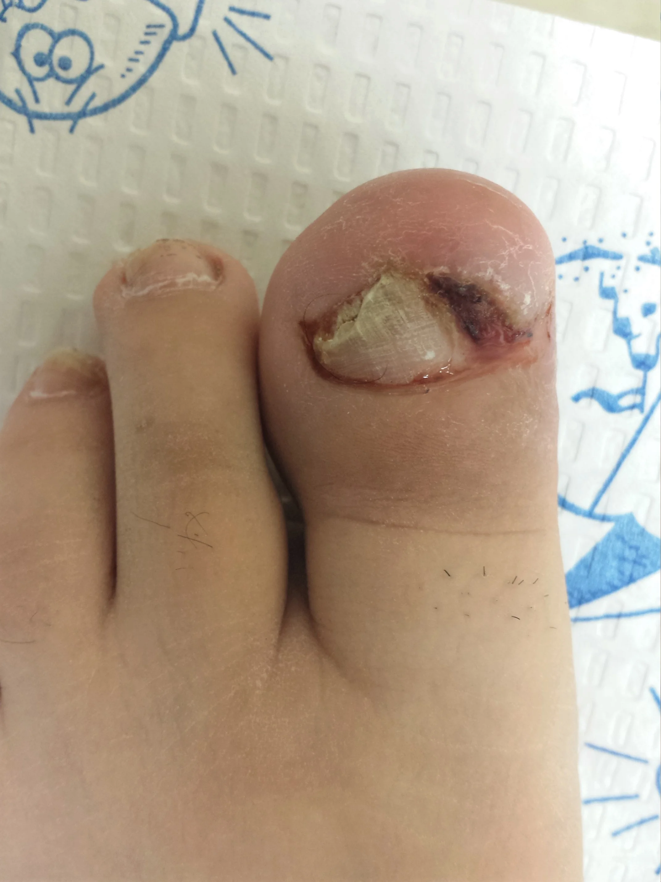 ingrown before01.jpeg