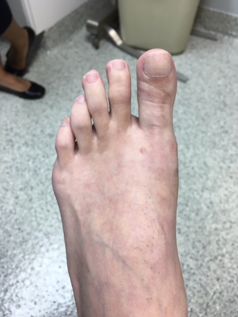After minimally invasive bunion surgery