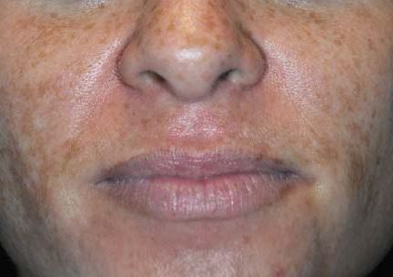 Perf 10 intermediate peel and home care regimen before.JPG